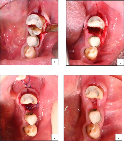 Clinical photographs showing (a) line of resection through furcation area and separation of mesial and distal segments, (b) surgical field after removal of resected half of tooth structure, (c) surgical field after suturing, (d) 2 weeks postoperative showing healing of soft tissue.