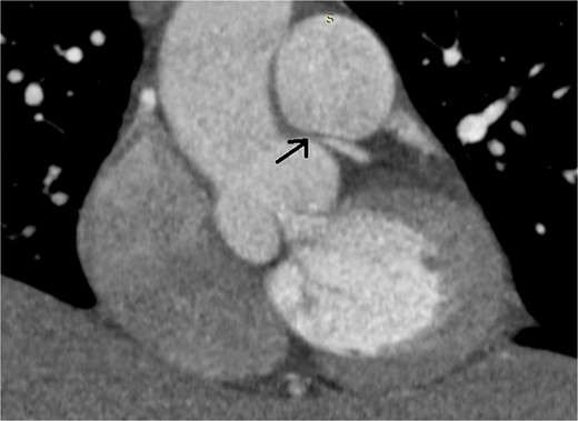Preoperative multislice computed tomographic coronary angiography revealing sub-total occlusion of left main coronary artery, starting at the ostium and extending 5 mm distally (arrow)