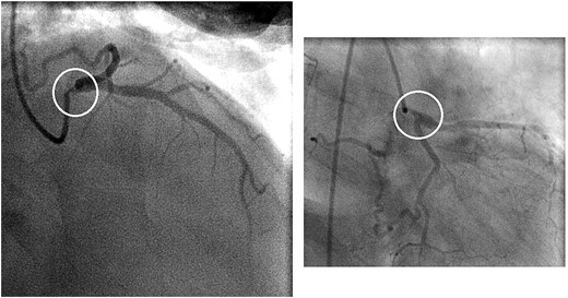 Preoperative coronary angiogram showing a 90% stenosis in the ostial and proximal shaft of the left main coronary artery (circles)