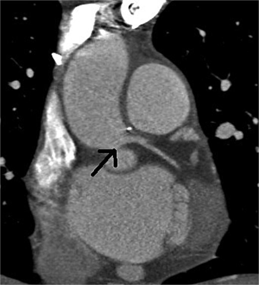 Postoperative multislice computed tomographic coronary angiography showing no signs of recurrent stenosis, with a widely open left main coronary artery (arrow)