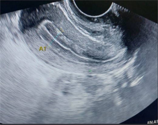 Endometrial thickness grossly normal.