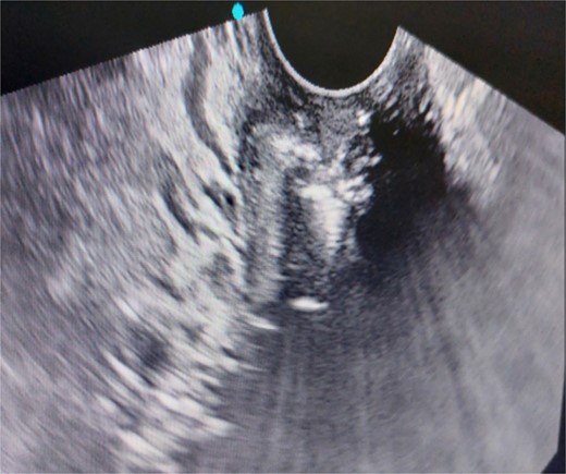 Foreign body seen in the endocervical canal.