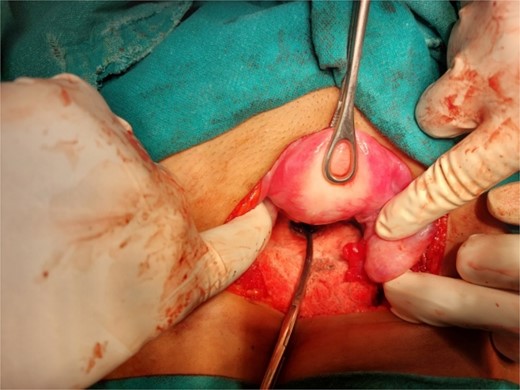 Laparotomy revealing the nozzle head in the lower uterine cavity.