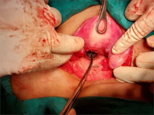 Extraction of the foreign body through a posterior hysterotomy incision.