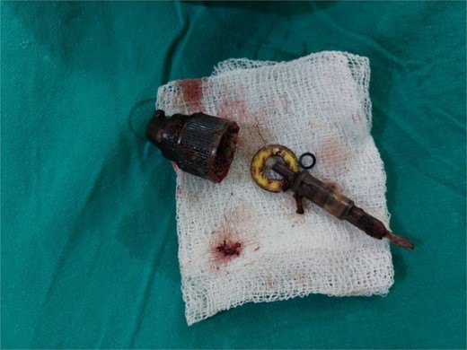 The perfume nozzle head retrieved from posterior hysterotomy and the nozzle with ring and spring removed vaginally.
