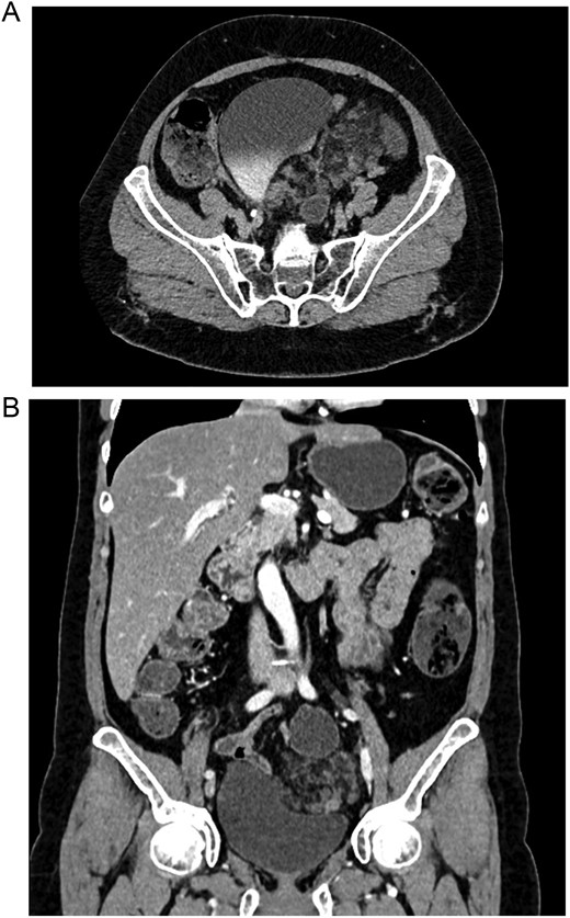 (A) CT, the lymphangioma is seen with heterogeneous densities. (B) CT, coronal view of the lymphangioma close to the bladder.