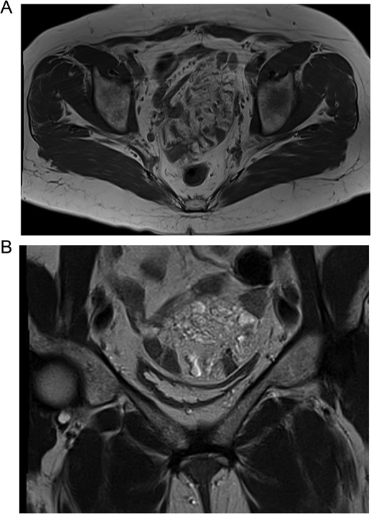 (A) MRI, the lymphangioma is seen close to the vaginal cuff and the pelvis. (B) MRI, the lymphangioma is seen arising from the mesentery of the small bowel.
