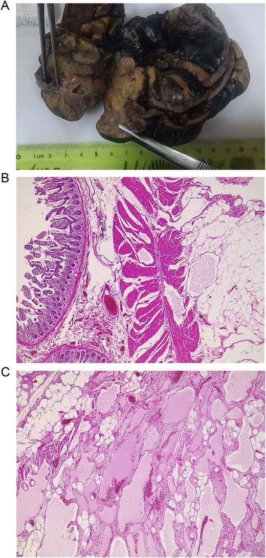 (A) Pathology; the segment of the ileum is seen with cysts in its mesentery, with the lymphangioma. (B) Mucosa of the ileum is seen alongside dilated lymphatic vessels surrounded by adipose tissue. (C) Dilated lymph vessels are seen in the mesentery of the ileum.