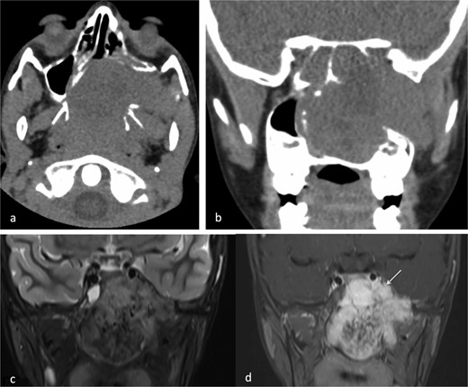 (a) Axial non-contrast CT of the paranasal sinuses showing a soft tissue mass obliterating the posterior aspect of the nasal cavity, with extension and remodeling of the left pterygopalatine fossa into the infratemporal fossa. (b) Coronal image demonstrating superior extension into the left sphenoid sinus and left inferior orbital fissure. (c) Coronal T2-weighted MRI showing a large JNA with heterogeneous signal intensity and multiple flow voids consistent with hypervascularity. (d) Post-contrast coronal T1-weighted MRI demonstrating avid contrast enhancement and invasion of the left Meckel’s cave and cavernous sinus (arrow).