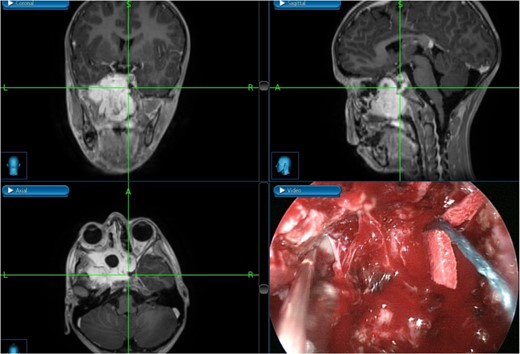 Tumor dissection from the right ICA using intraoperative navigation assistance,with real-time display of instrument location in axial, coronal, and sagittal views.