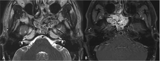 (a) Transaxial T2-weighted MRI image showing a mass with heterogeneous signal intensity and multiple flow voids, along with thinning of the cortical bone overlying the left ICA (arrow). (b) Post-contrast transaxial T1-weighted MRI image demonstrating avid contrast enhancement of the JNA.