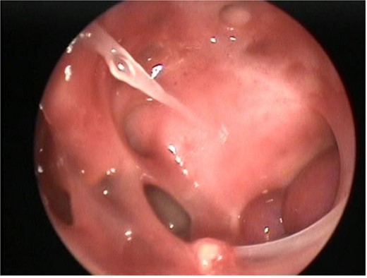 Postoperative nasal endoscopy showing the left ICA within the left lateral sphenoid sinus.