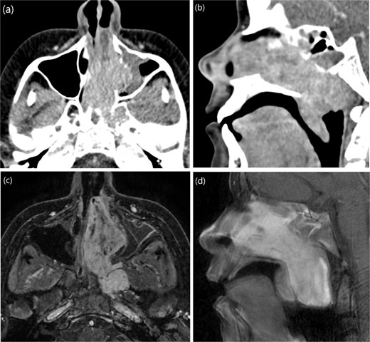 (a, b) Contrast-enhanced CT of the paranasal sinuses in transaxial and sagittal views showing a mass in the left nasal cavity with extension into the nasopharynx. (c, d) Post-contrast T1-weighted MRI in axial and sagittal views illustrating the mass extending laterally into the maxillary antrum and left pterygopalatine fossa, as well as posteroinferiorly into the oropharynx.