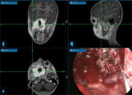 Intraoperative post-excision navigation-assisted images demonstrating the complete removal of the tumor from the far lateral boundary of the infratemporal fossa in axial, coronal, and sagittal views.