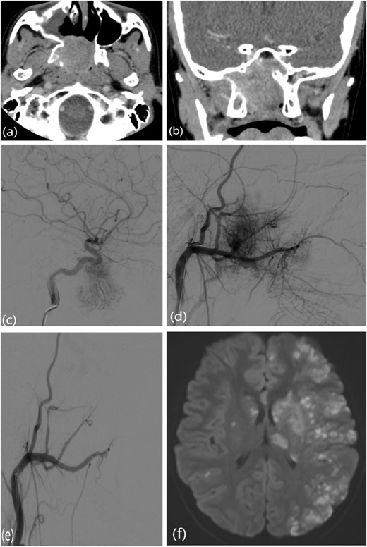 (a, b) Contrast-enhanced CT of the paranasal sinuses showing a right nasopharyngeal mass with extension into the sphenoid sinuses and right pterygoid plate. (c) Lateral projection angiogram of the right ICA demonstrating the blood supply to the right nasopharyngeal mass from the inferolateral trunk. (d) Lateral projection angiogram of the right ECA showing extensive vascular supply to the hypervascular mass from multiple branches. (e) Post-embolization right ECA angiogram showing devascularization of the tumor. (f) Transaxial diffusion-weighted imaging of the brain showing extensive foci of restricted diffusion, predominantly involving the left side, consistent with acute stroke.