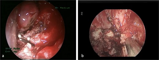 (a) The sphenopalatine artery is clipped before tumor removal. (b) The vascular tumor is dissected from sphenoplataine and pterygopalatine fossa.