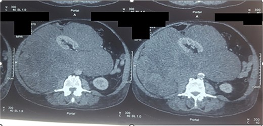 Axial section of CT scan, parenchymal window showing a large retroperitoneal mass measuring 40 × 27 × 17 cm (liposarcoma).
