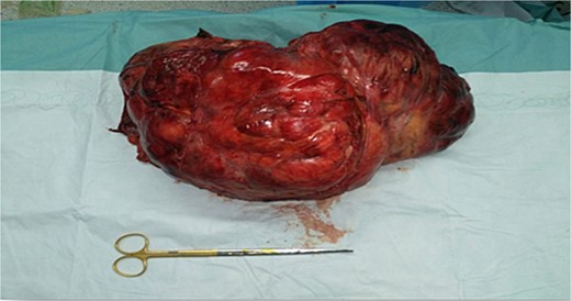 Surgical specimen showing resected liposarcoma.