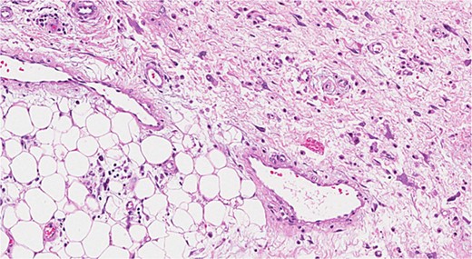 Dedifferentiated liposarcoma. This image shows a high-grade tumor.
