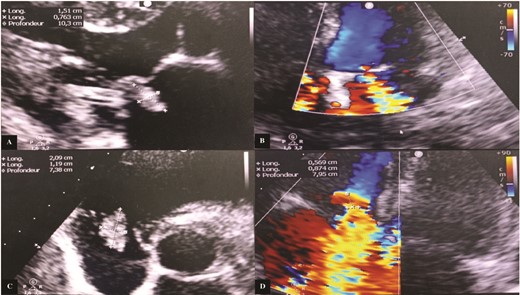 Transthoracic echocardiography images. (A) Vegetation attached to the atrial side of the anterior mitral leaflet measuring 15 × 7.6 mm. (B) Significant mitral regurgitation. (C) Vegetation attached to the free edge of the anterior tricuspid leaflet measuring 21 × 12 mm. (D) Massive tricuspid regurgitation.