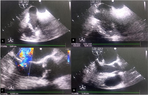 Transesophageal echocardiography images. (A) Incidence 113° showing vegetation attached to the free edge of the anterior tricuspid leaflet measuring 26.3 mm in long axis. (B) Surface area of the vegetation attached to the anterior tricuspid leaflet estimated at 2.51 cm2 and circumference of 8.06 cm. (C) Color Doppler showing significant mitral regurgitation. (D) Incidence 113° showing vegetation attached to the large mitral leaflet measuring 15 mm in long axis.