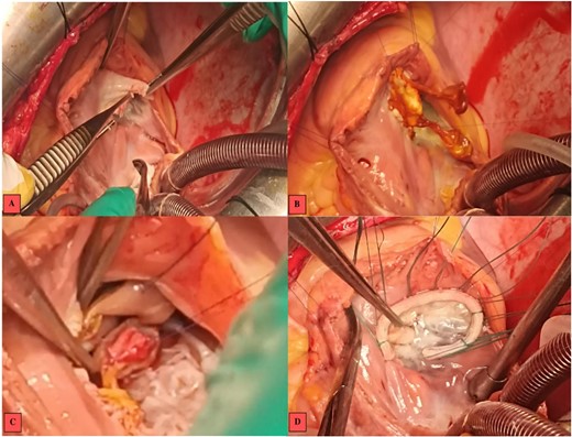 Intraoperative images. (A) Vegetations on the anterior tricuspid leaflet. (B) Valvular suture of the mitral autograft to the native tricuspid annulus. (C) Suture of the anterior papillary muscle of the mitral autograft to the interventricular septum. (D) Tricuspid annuloplasty ring with no residual regurgitation at serum testing.