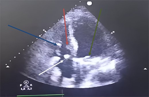 Postoperative transthoracic echocardiography, four chambers showed at 1 month. Green arrow: mechanical mitral prosthesis in place without stenosis and without detectable leakage. White arrow: tricuspid coaptation without detectable leakage, with slight excess fabric at the suture line on the anterior tricuspid leaflet. Blue arrow: inferior tricuspid papillary muscle. Red arrow: anterior tricuspid papillary muscle.