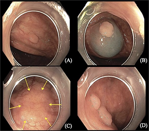 Colonoscopy images show (A, B, and D) sessile polyps found in the proximal transverse colon and rectum. (C) Flat irregular polyp near the colonic splenic flexure measuring 20 × 40 mm.
