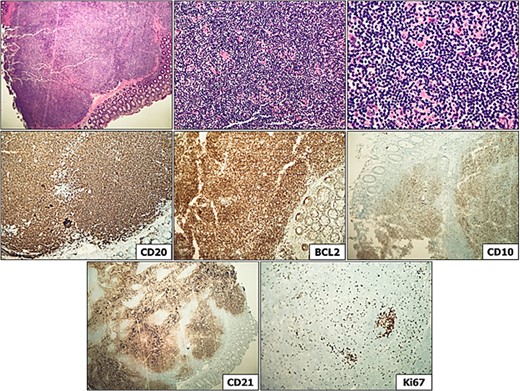 Distal transverse colon polyp, consistent with grade 1 follicular lymphoma. Immunostaining is evidenced above, demonstrating CD20 (lymphocyte positivity), BCL-2 (bright), CD10 (B cell positivity), CD21 (demonstrating markedly expanded and disrupted follicular dendritic meshwork), and Ki-67 staining demonstrating low proliferation index (10%–20%) in lymphoma cells, with high proliferation index (>90%) in the residual reactive germinal centers.