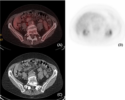 (A) and (B) show axial PET scan sections with 2.2 uptake in the liver. There is no abnormal colonic uptake. Specifically, there is no uptake seen in the splenic flexure corresponding to the mass described on the prior colonoscopy. (C) Computerized tomography shows no mediastinal lymphadenopathy and no axillary lymphadenopathy. Liver and spleen not enlarged. A prominent left inguinal lymph node was noted without evidence of abnormal FDG activity.