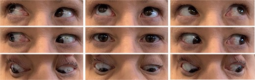 Extraocular motility demonstrated in 9 gaze.