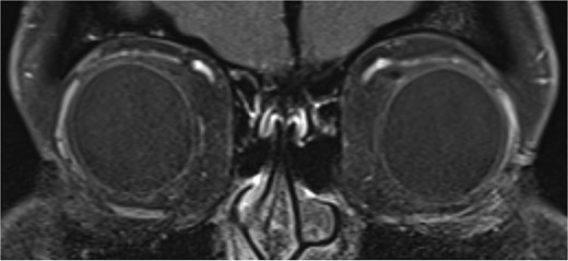 T1 coronal image of orbits which shows normal symmetrical superior obliques.
