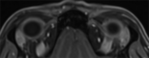 T1 axial image of orbits which shows a normal trochlear-tendon complex.
