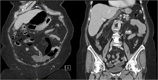 Two coronal images from a computed tomography (CT) scan of the abdomen and pelvis with intravenous contrast demonstrating the cecum herniating through the foramen of Winslow with no signs of ischemia or bowel obstruction.