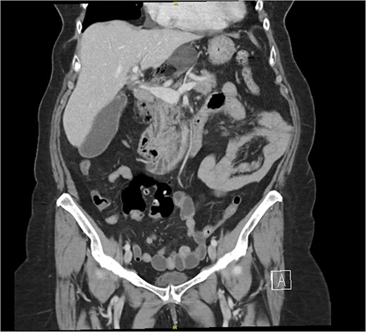 A computed tomography (CT) scan of the abdomen and pelvis with intravenous contrast demonstrating a distended gallbladder with pericholecystic stranding and surrounding portal triad inflammation.
