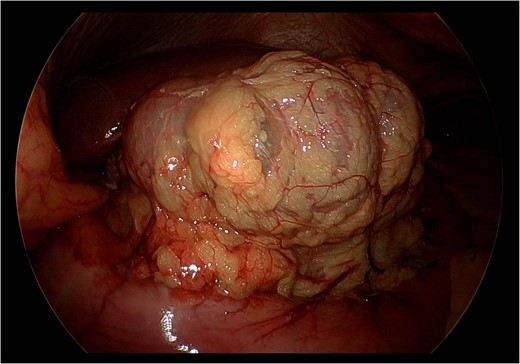 Still photograph obtained during exploratory laparoscopy demonstrating cecal herniation through the foramen of Winslow.