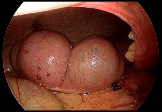 Still photograph obtained during exploratory laparoscopy demonstrating complete reduction of the cecum from the lesser sac without signs of ischemia or necrosis.