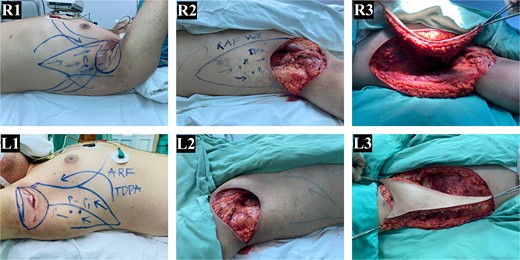 Bilateral stage III axillary HS and TDAP flap reconstruction. (R1-L1) preoperative image showing bilateral axillary HS and the freestyle V-Y advancement flap design based on the musculocutaneous perforators of the thoracodorsal artery. (R2-L2) post-excision of all hair-bearing axillary skin, revealing the axillary defect. (R3-L3) intraoperative movement of the TDAP flaps for defect closure (R: Right, L: Left).