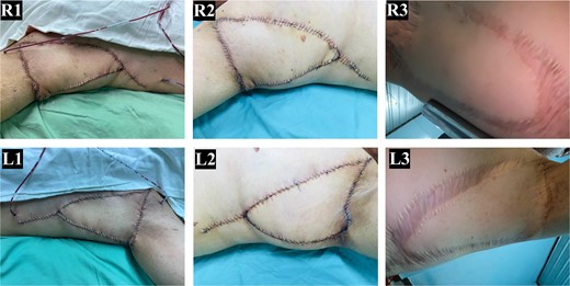 TDAP flap closure and postoperative outcomes. (R1-L1) intraoperative closure of the axillary defect with TDAP flaps. (R2-L2) healed flap wound with a fully functional range of motion of the shoulder, observed at 2 weeks postoperatively. (R3-L3) follow-up at 3 years demonstrating successful healing and sustained functional outcomes (R: Right, L: Left).