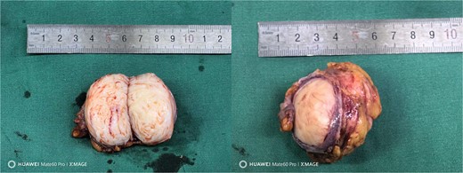 Excision tumor specimen.