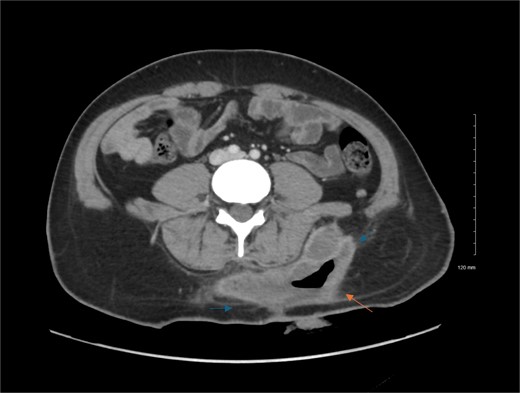 Contrast enhanced axial CT scan of the abdomen. Contrast enhanced CT scan of the abdomen shows left lower back fluid collection with peripheral thick wall enhancement (blue arrows), consistent infected collection. There is also air seen within the collection (orange arrow), indicating prior attempted evacuation.