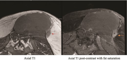 Private hospital MRI. Axial T1 MRI (left) shows left rounded low T2 signal intensity lesion (orange arrow), which shows hyperenhancement (green arrow) on axial T1 fat saturated postcontrast images (right).