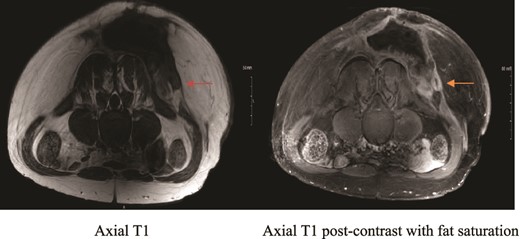 MRI showing suspicious lesion. Postoperative MRI images show re-demonstration of suspicious lesion when correlated to prior MRI from private hospital. The lesion shows low T1 signal intensity (orange arrow), and post-contrast enhancement with central linear area of non-enhancement.
