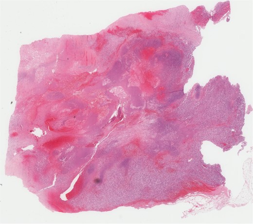 Microscopic pathology confirming the diagnosis. Pathology report: five cores of white to gray-tan soft tissues, the smallest measuring 0.4 × 0.1 × 0.1 cm and the largest measuring 1.3 × 0.1 × 0.1 cm. Diagnosis: angiosarcoma.