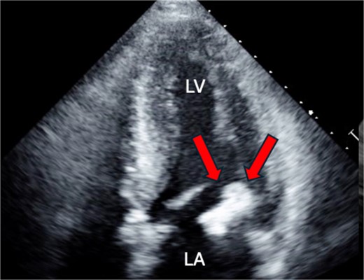 Preoperative cardio echography showing fraction EF 63%, LVDd 50 mm, LVDs. 35 mm, and a 3-cm size of mobile mass.