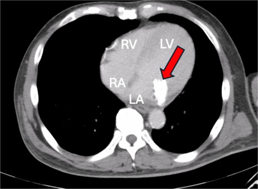 Cardiac CT showing severe MAC.