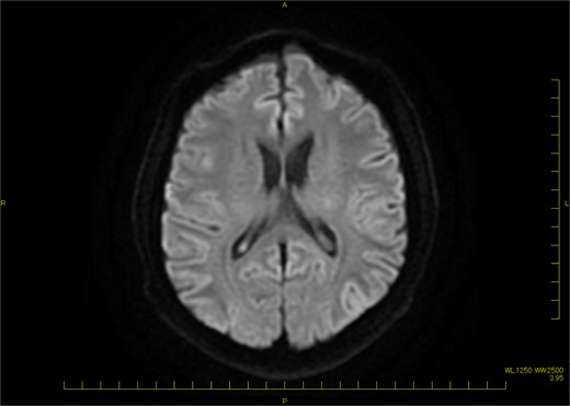 Brain MRI (DWI) showing no acute lesion.