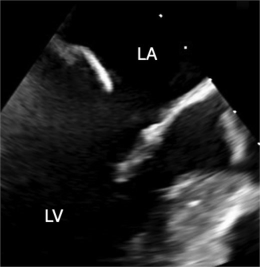 Preoperative transesophageal echocardiography showing disappearance of the mass.