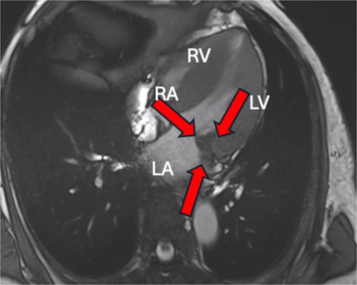 Cardiac MRI showing a hypointense mass on axial T2-weighted.