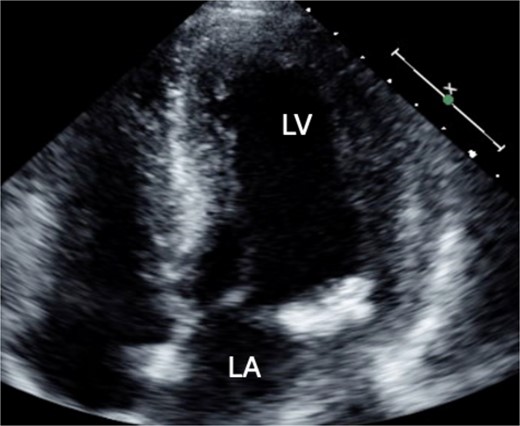 Preoperative TTE showing no mobile mass.